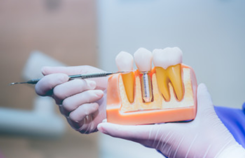 dental implants Nashville